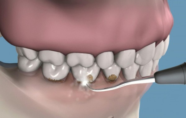 03-limpieza-dental-profilaxis