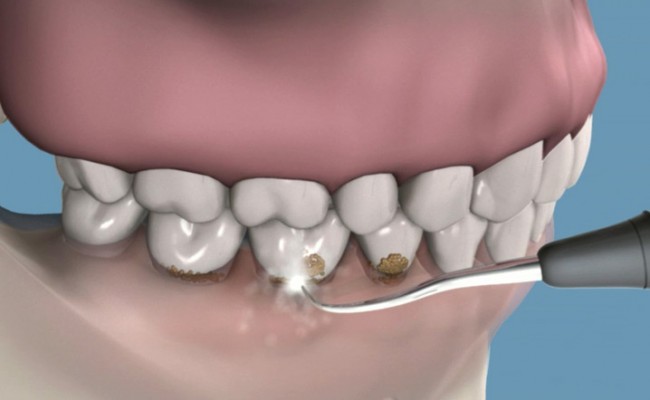 03-limpieza-dental-profilaxis