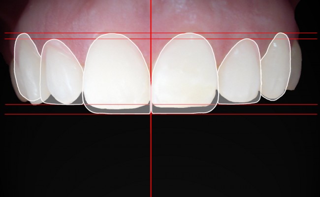 digital-smile-desing-dsd-disec3b1o-disec3b1o-de-sonrisa-digital-maracaibo-clinica-odontologica-imagen-dental