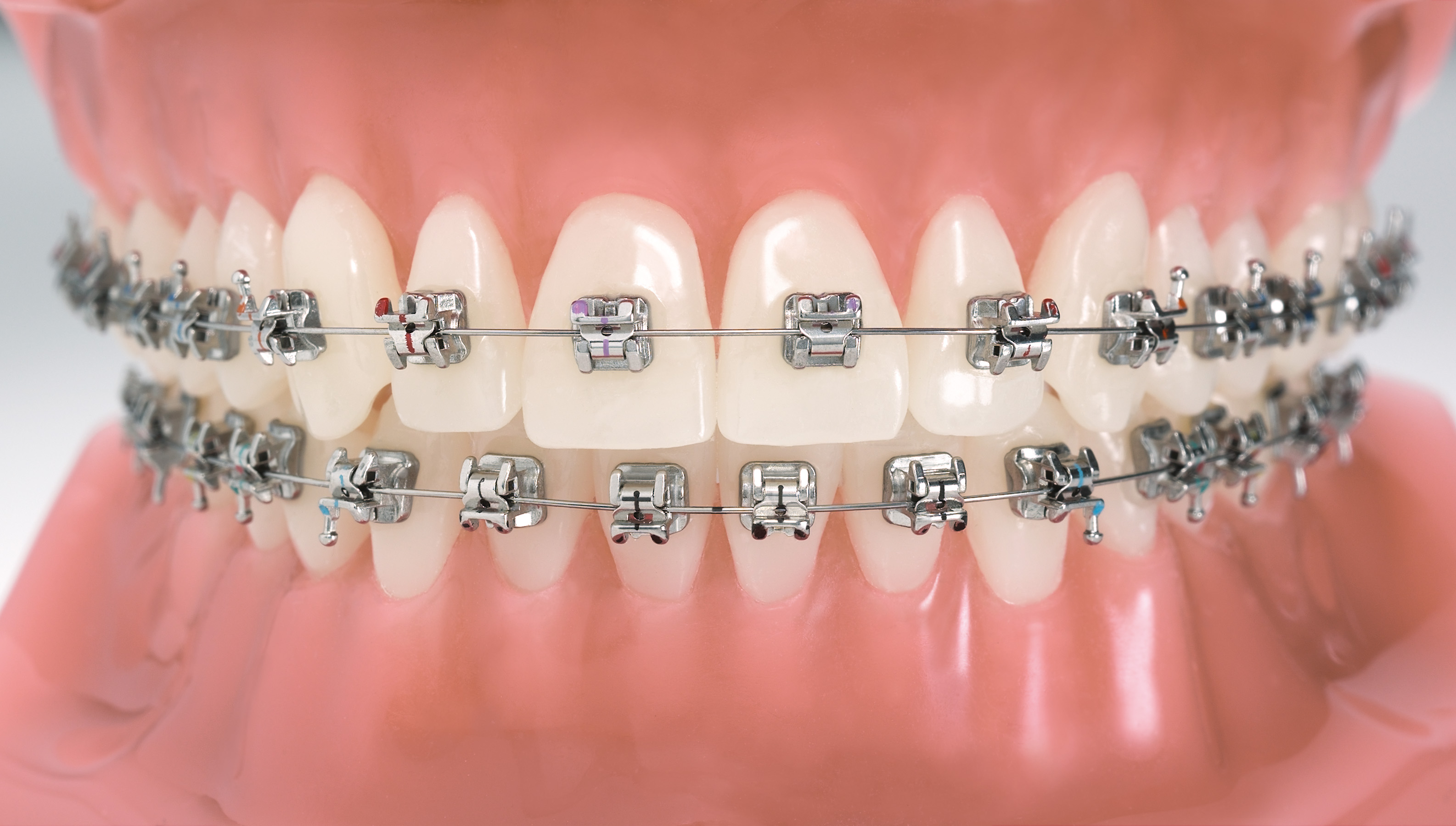 ortodoncia-brackets